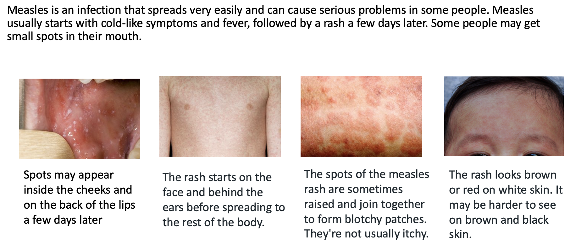 Common signs and symptoms of measles